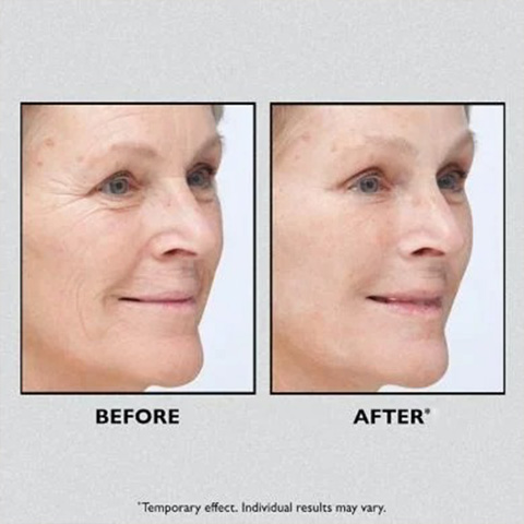 InfiniteTight® – Lifting Facial Inmediato